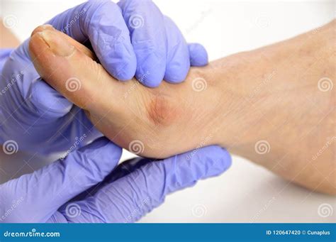 Blood Blister On Foot