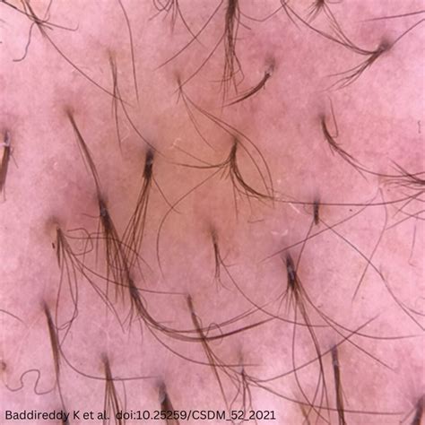 Black Spots on Nose: What Is Trichostasis Spinulosa? | Dr Raechele Derm