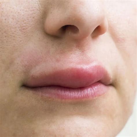 What is the disease of waking up with a swollen upper lip? Causes and treatment
