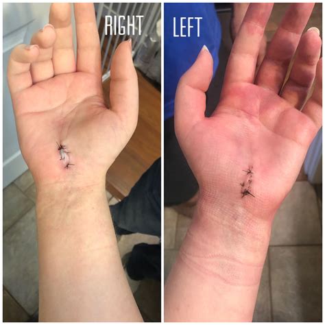 Heat After Carpal Tunnel Surgery at Isabella Embry blog