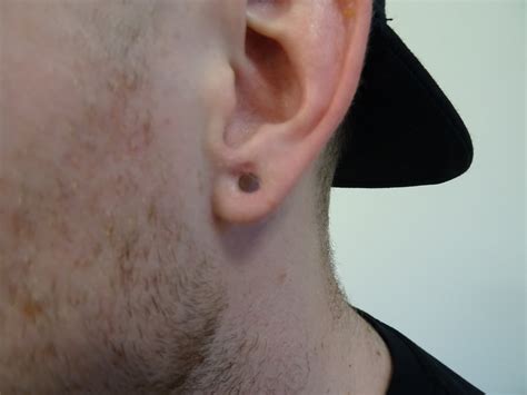 Can You Pierce Ear With Keloid at Paul Brower blog