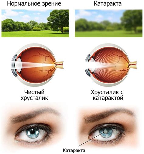 Катаракта - стадии развития и методы лечения - Офтальмологические ...