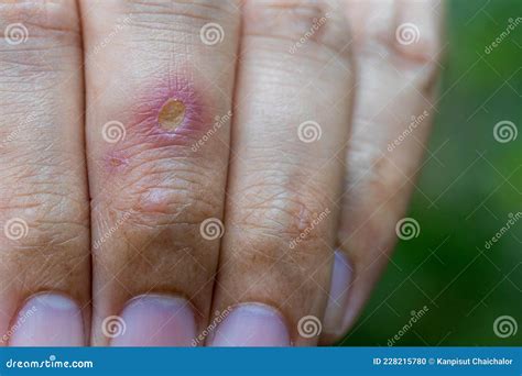 Finger Infection Burning Sensation at Wanda Hatton blog