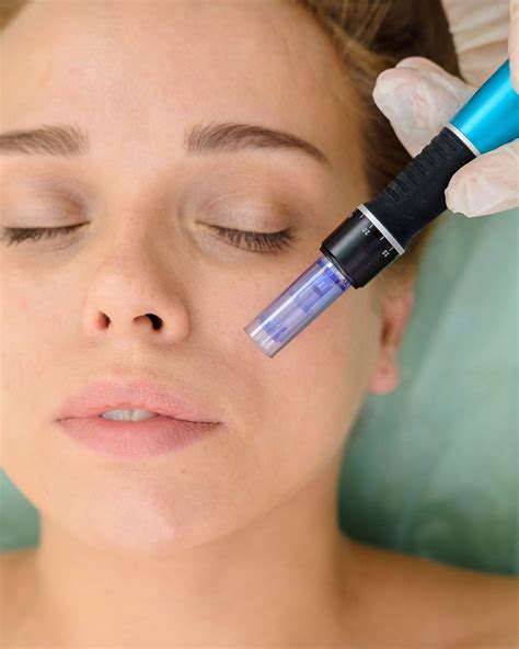 What Is Microneedling With Radio Frequency at Georgia Challis blog