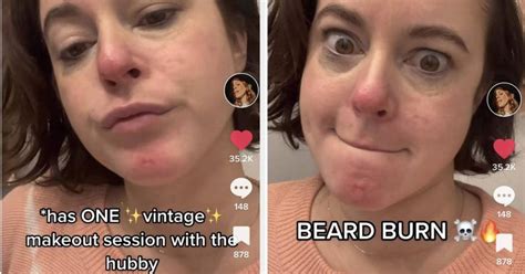 Women Are Speaking Up About Chin Infections From Kissing Their Bearded ...