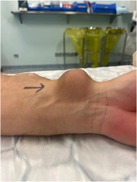 Radial Artery Aneurysm Arising from the Stump of a Ligated ...