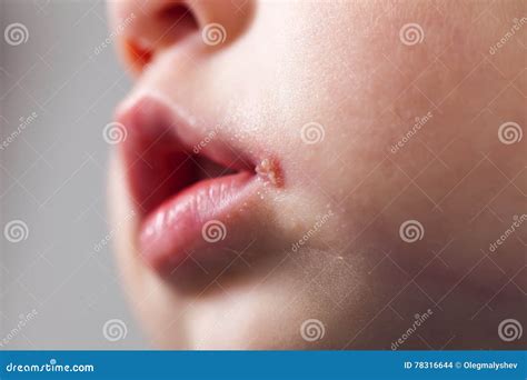 Mouth Herpes Baby at Frank Royalty blog