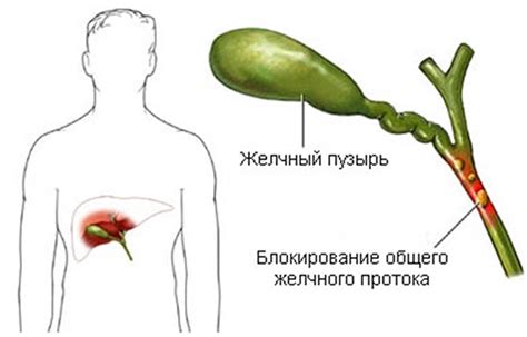 Дискинезия желчного пузыря: препараты и как лечить