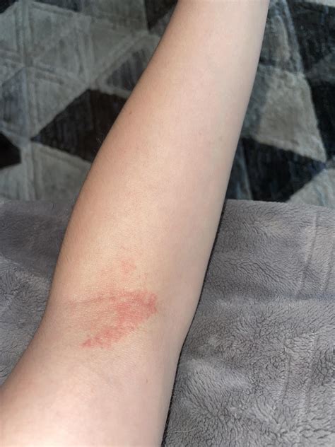 Heat Rash On Elbows Skin Rashes In Summer Are Common — Here's How To