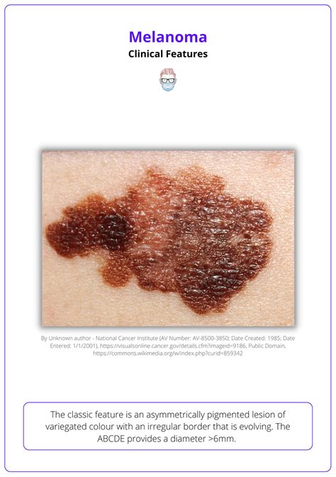 Stage 2 Melanoma