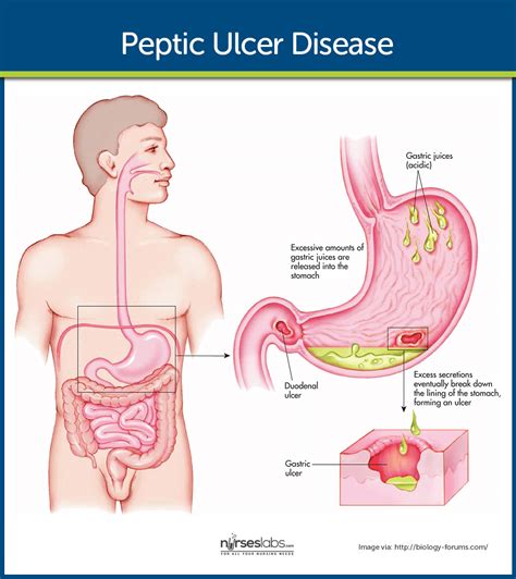 Peptic Ulcer Disease Nursing Care and Management - Nurseslabs