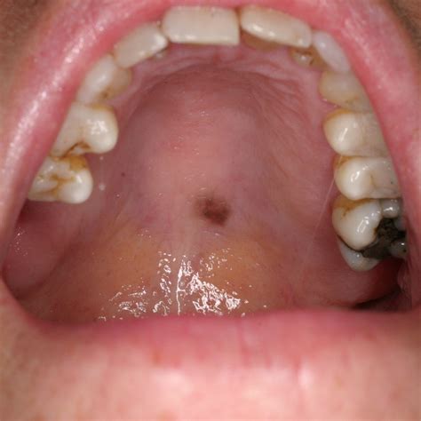 Roof Of Mouth Yellow Color