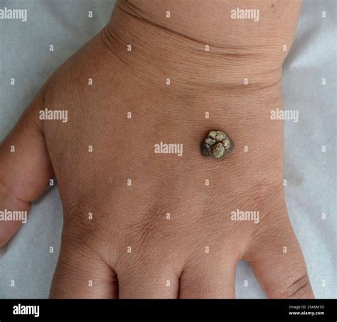 Common wart on the hand of a 49 year old female patient. Warts are harmless, contagious growths ...