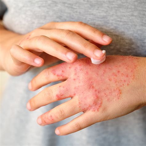 Hand eczema (hand dermatitis) | South West Dermatology