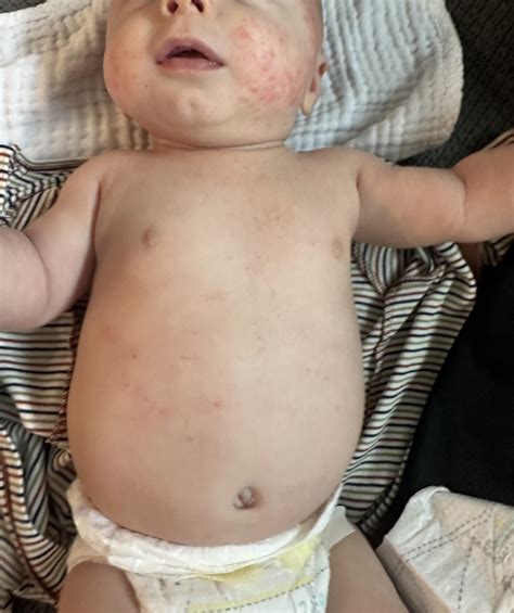 Pregnancy Rash On Stomach Viral Rash Baby: Pictures, Types, And