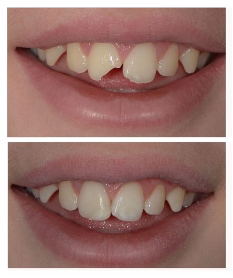 What to Do When Your Child Breaks a Front Tooth: Exploring Options | Complete Family & Aesthetic ...