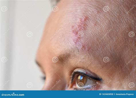 Facial Herpes Cause at Matthew Brunskill blog