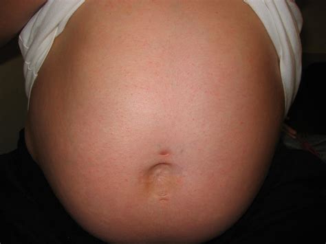 Derm Dx: Itchy Rash on the Chest and Abdomen of a Pregnant Woman ...