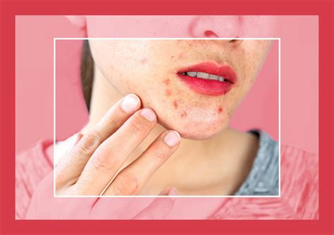 How to Pop a Pimple In the Safest Way Possible | Pimples, Acne cure ...