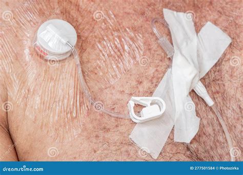 Tube for Intravenous Fluids Injections To Implantable Port for Chemotherapy Stock Photo - Image ...