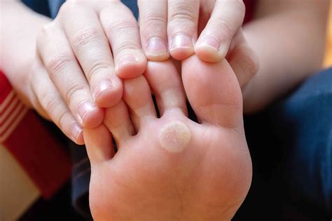 Bump on Bottom of Foot: 9 Causes and How to Get Rid of It - Hollywood Nuts