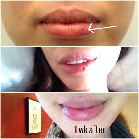 What Is The Meaning Of Mole On Lips | Lipstutorial.org