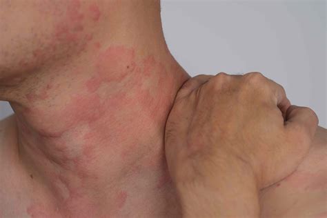 Itchy Rash On Neck And Chest Rash On Hands: Causes And When To Speak