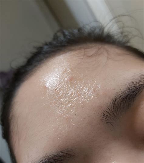Fungal acne on forehead? Perioral dermatitis on chin? : r/SkincareAddicts