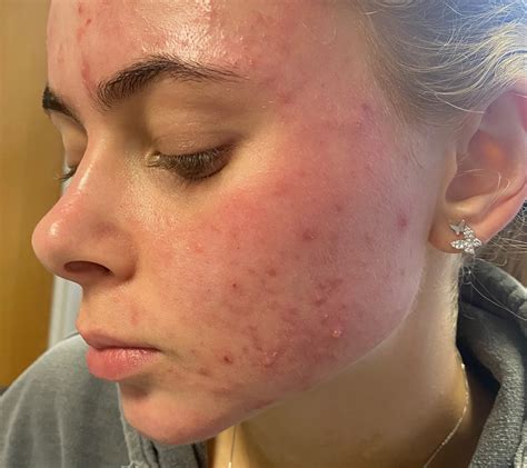 Best Cheek Acne Treatment Liverpool | Recurring Cheek Acne