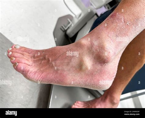 Athletes Feet Fungal Infection