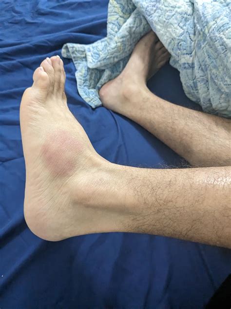 Rolled Ankle : r/medical