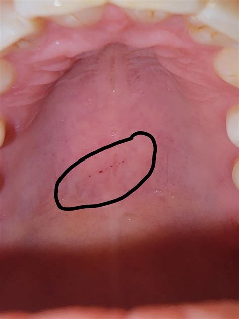 Concerned about these black dots on the roof of my mouth. : r/askdentists