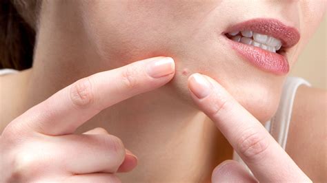 This Gruesome Pimple-Popping Video Is (Almost) Too Hard to Watch | Allure