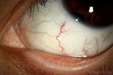 Melanocytoma of the Iris and Ciliary Body