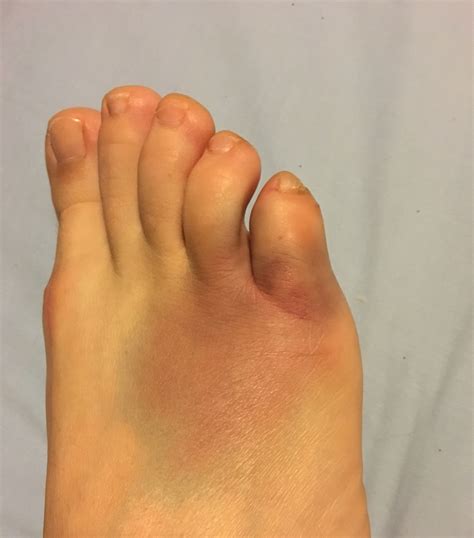 Sprained Toe
