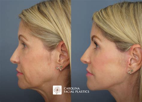 Lower Face Neck Lift with Platysmaplasty, Lower Blepharoplasty & Fat Grafting - Carolina Facial ...