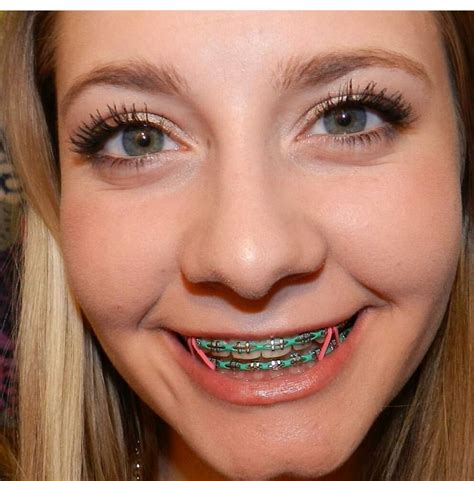 Pin by elpotrillo31 on Braces | Braces colors, Teeth braces, Dental braces