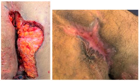 Factors Affecting Wound Healing after the Wide Surgical Excision of Hidradenitis Suppurativa Lesions