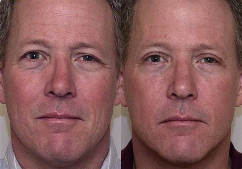 Eyelid Surgery (Blepharoplasty) Before and After Photo Gallery | Atlanta, Georgia | Buckhead ...