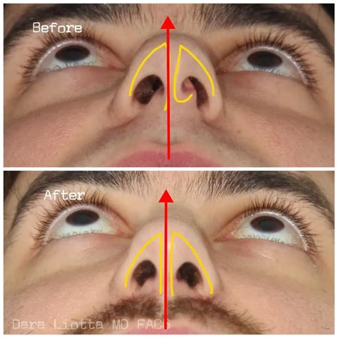 Septoplasty Before and After - Before After Journey