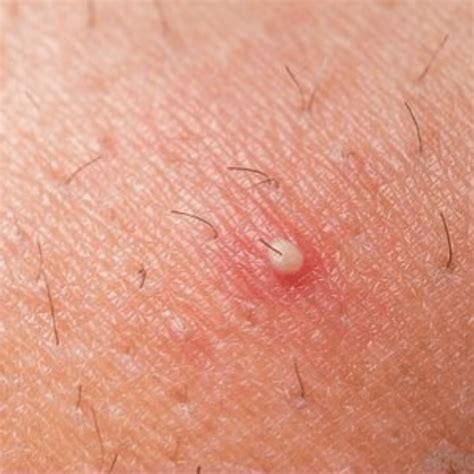 Types of Acne - Dr Terry Loong