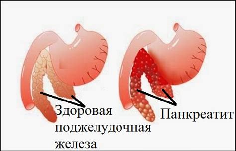 Как вылечить хронический панкреатит: его причины и последствия