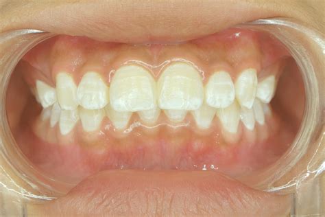 White Spots On Gums