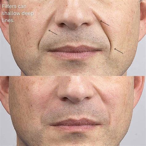 Best Nasolabial Fold Treatments In Australia | Dr Davin Lim