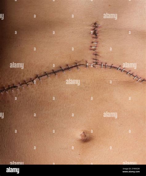 Closeup of medical staples helping a surgical incision and scar heal ...