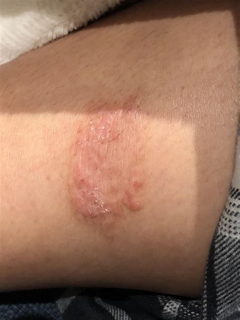Nummular Eczema Vs Ringworm