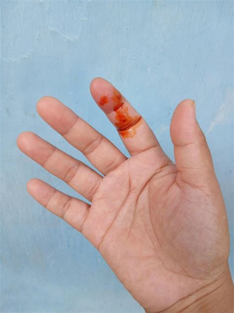 A dog bite wound and blood on hand. Infection and Rabies concept ...