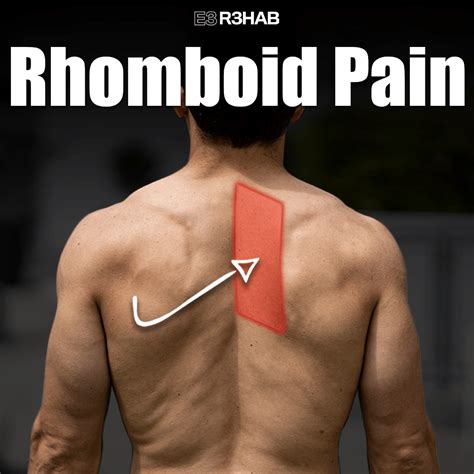 Rhomboid Trigger Points A Pain Between The Shoulder