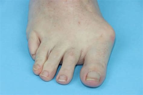 What Are Bunions? - At North Texas Podiatry Associates