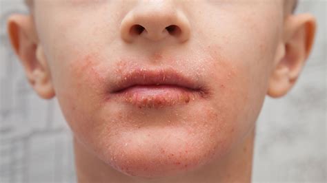 What Does Perioral Dermatitis Look Like? - GoodRx